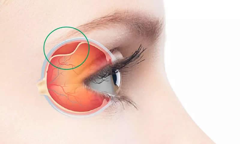 Sintomas do descolamento de retina