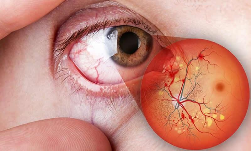 Laser para tratamento do edema macular diabético