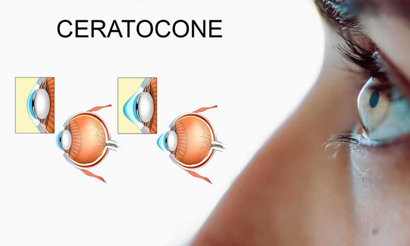 Saiba quais são os Tratamentos Cirúrgicos para Ceratocone