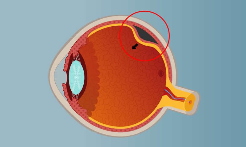 Como evitar o descolamento de retina?