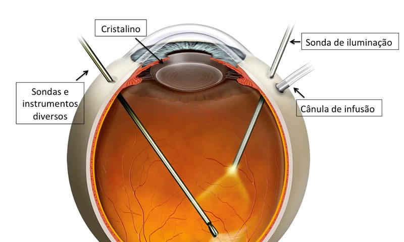 A vitrectomia dói? Sente dor após a cirurgia de retina?