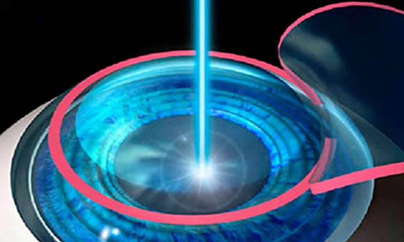 Cuidados no pré-operatório para Cirurgia Refrativa