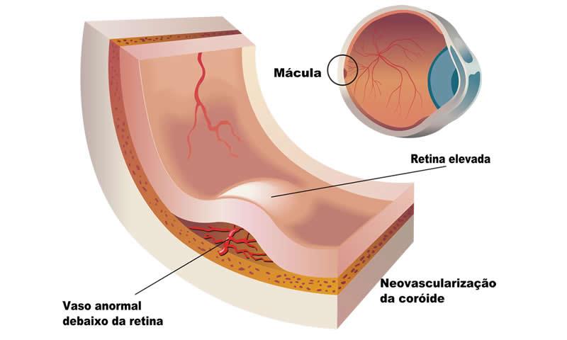 Quais os fatores de riscos para a Degeneração macular?