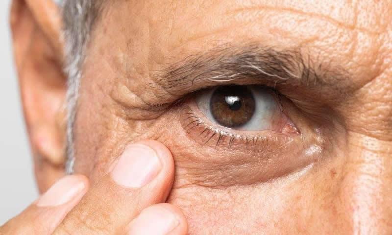 Conheça os quatro tipos principais de glaucoma