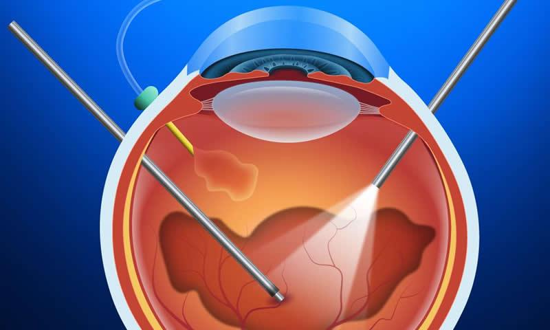 Saiba mais sobre a Vitrectomia e Retina